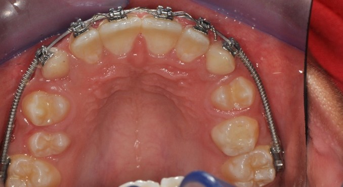 Interceptive orthodontic treatment is done to expand the patient’s jaw using braces and springs at Jasbir Dental Specialist Melaka.