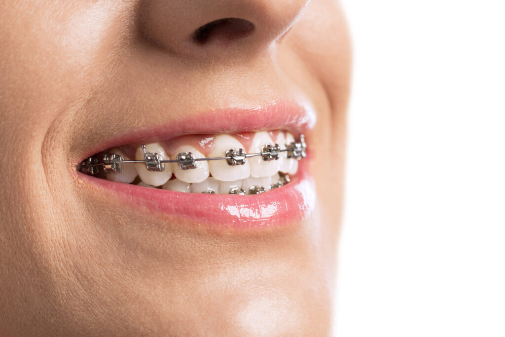 Smiling patient with beautiful straight teeth wearing Damon Self Ligating Braces.