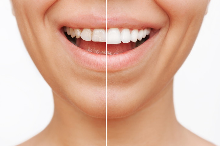 Before and after treatment of a smile makeover from crooked and uneven teeth to a beautiful smile.