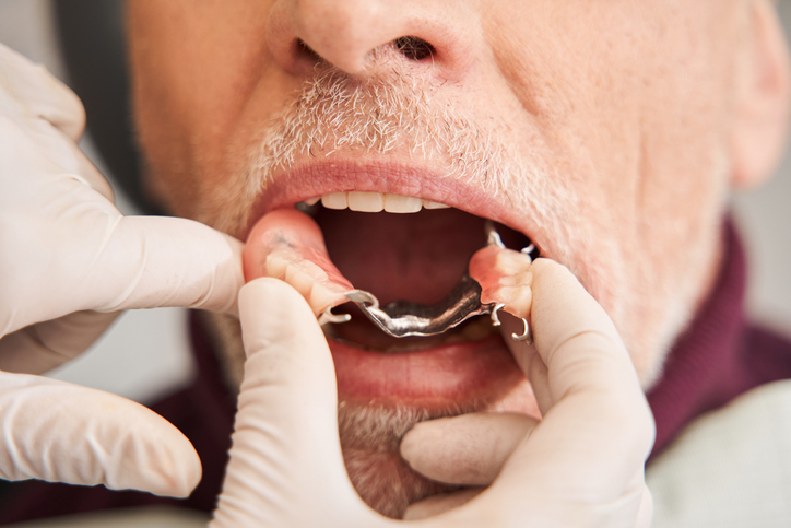 The dentist inserts a cobalt chrome partial denture into a male patient’s mouth.