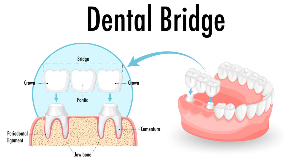 Infographic of human in dental bridge on white background