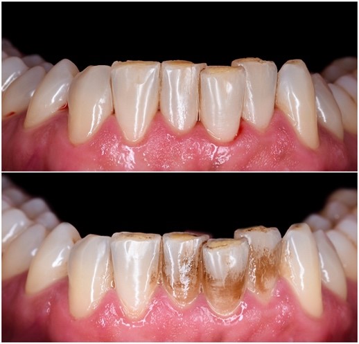 Before and after picture of EMS Air Flow Oral Spa treatment showing removal of plaque and teeth stains