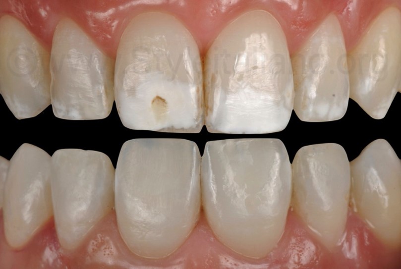 Before and after treatment of white spot lesions on teeth using Icon Resin Infiltration.