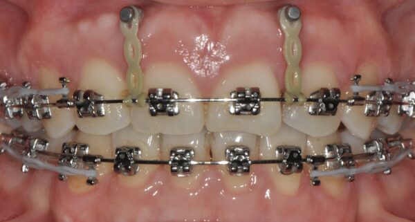 Temporary Anchorage Device (TAD) being used in a patient wearing braces to correct gummy smile at Jasbir Dental Specialist Melaka.