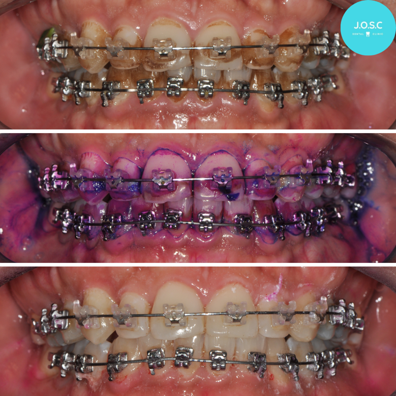 EMS Air Flow Oral Spa treatment from patient wearing ceramic braces and having stains on his teeth to disclosing agent application to clean and sparkly teeth with ceramic braces at Jasbir Dental Specialist Melaka